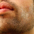 Dry skin image