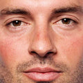 Face redness image