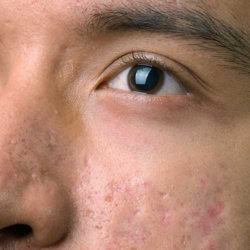 Acne scrars image