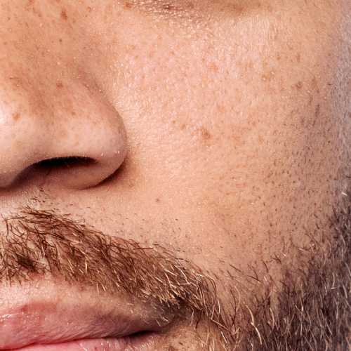 Dark spots image