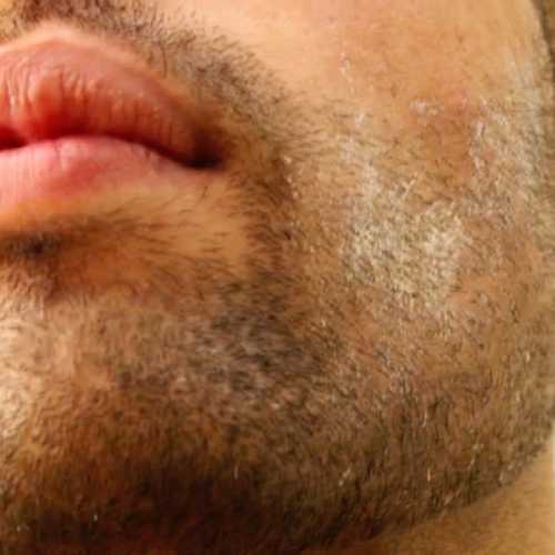 Dry skin image