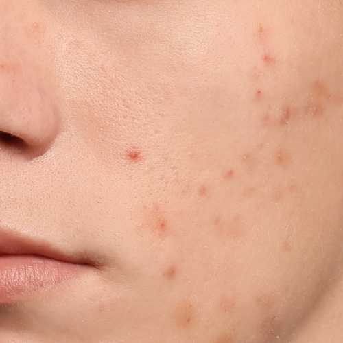 Oily breakouts image